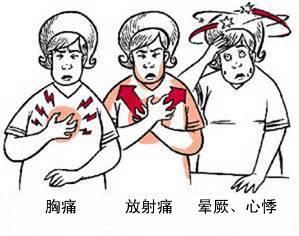 冠心病有哪些癥狀？(圖1)