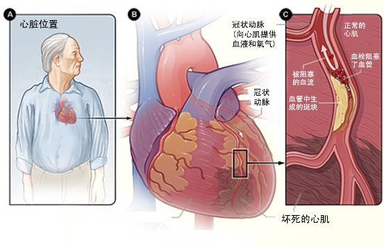 怎樣治療冠心??？(圖3)