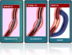 怎樣治療冠心??？
