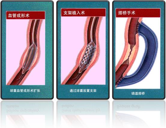 怎樣治療冠心??？(圖1)